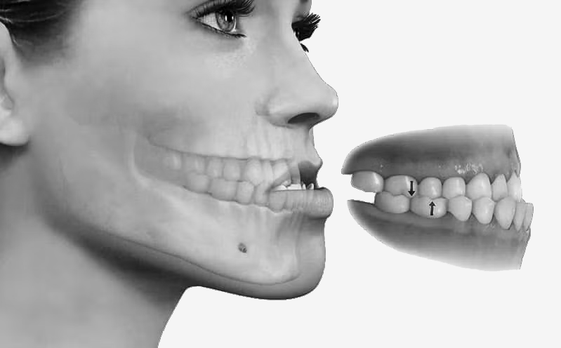 Ejemplo de prognatismo mandibular como imagen destacada del blog